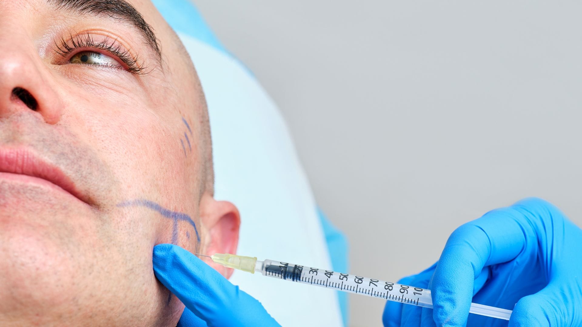 Botox para tratar el bruxismo