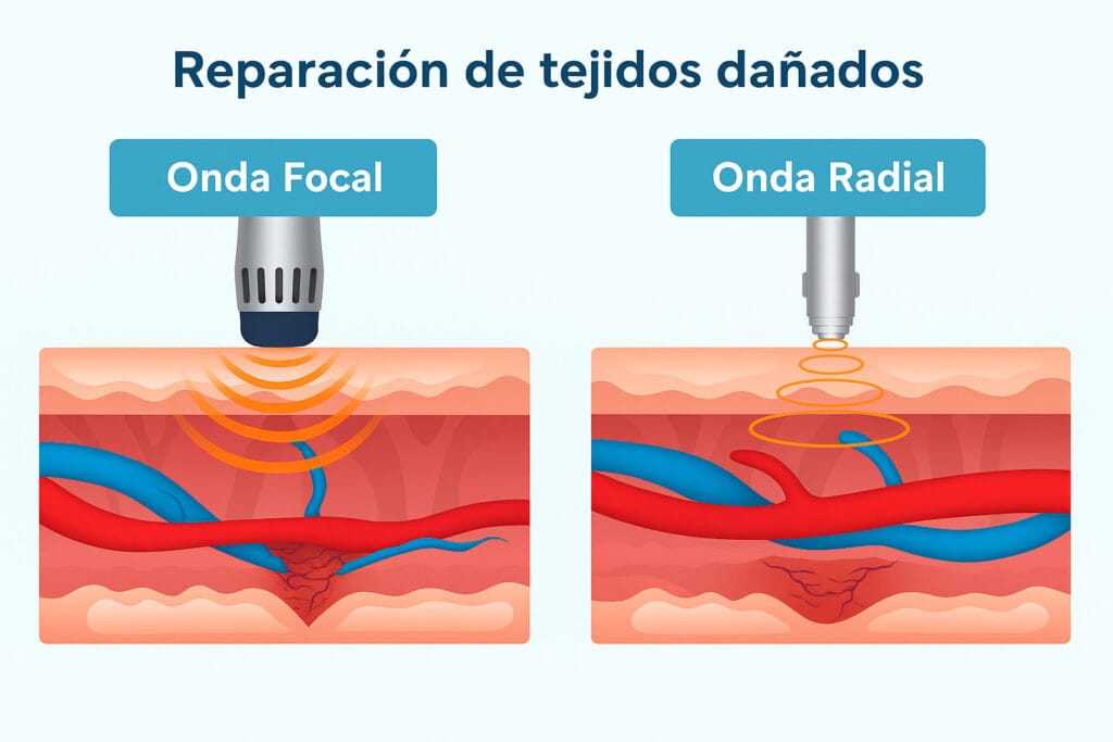 Ondas de choque: qué son, beneficios y cuándo se usan